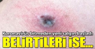 Koronavirüs bitmeden yeni salgın başladı! Belirtileri...